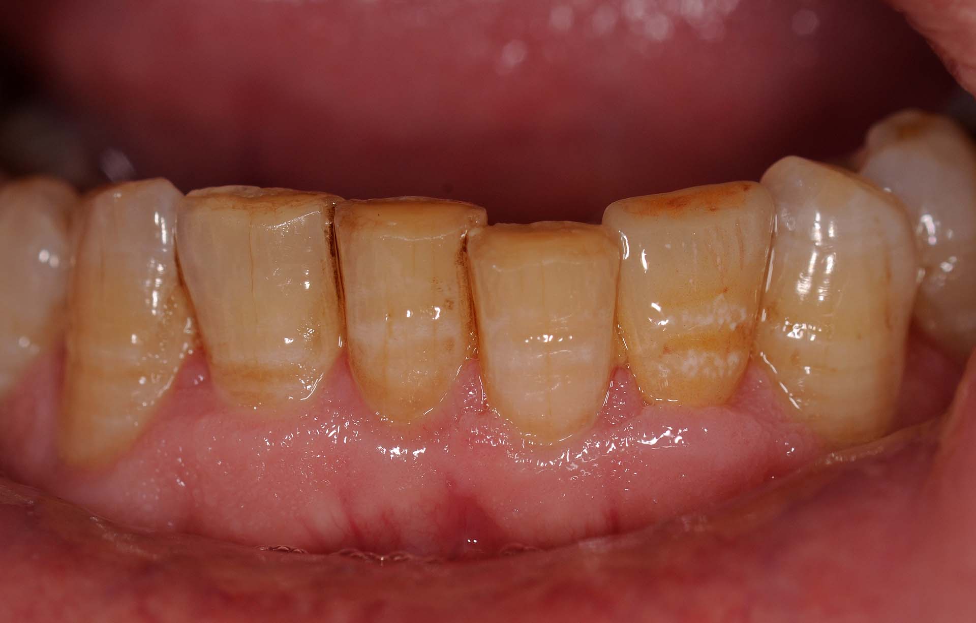 Veneer 32